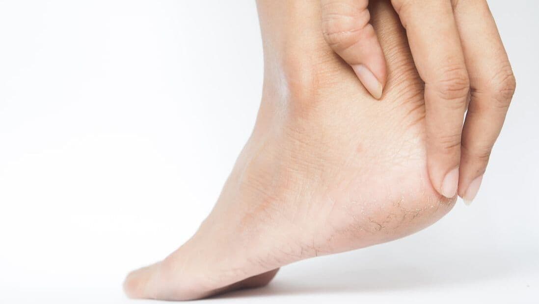 Hard hud og sprekker