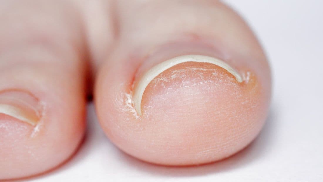 Inngrodd negl / nedgrodd negl