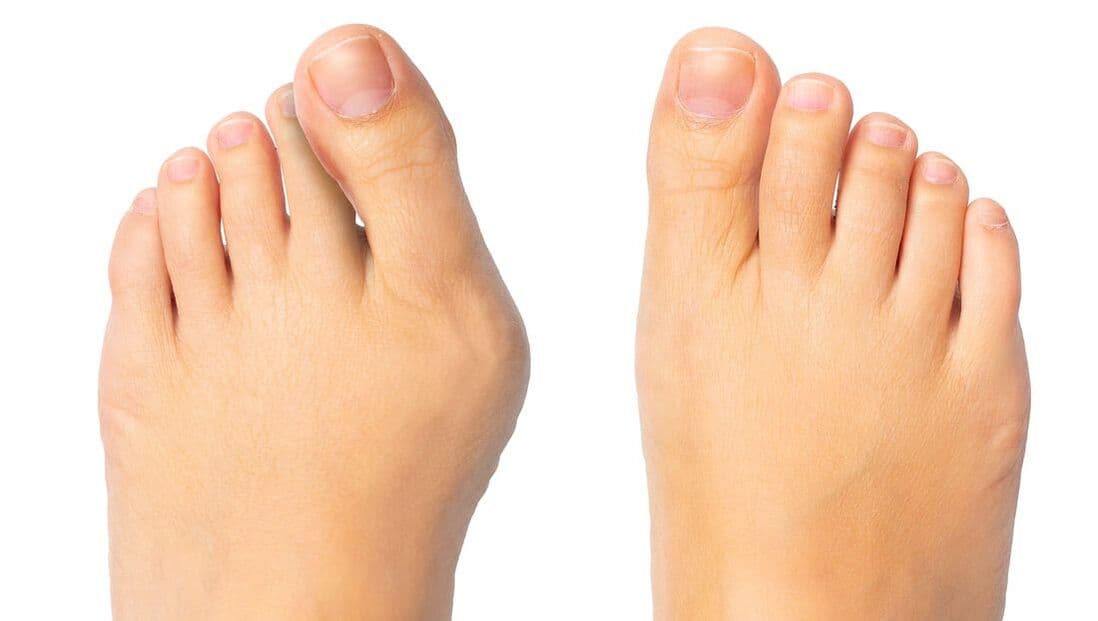 Skjevstillinger i tær