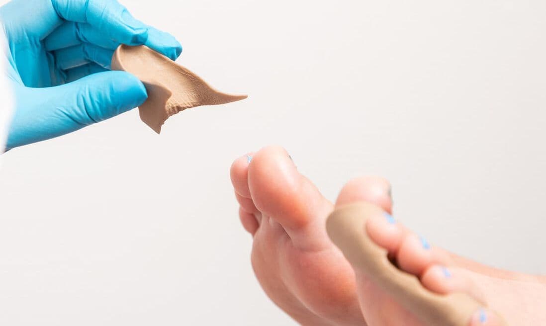 Forfotortose / Silikonavlastning