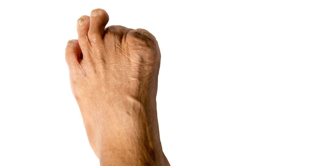 Komplikasjoner ved diabetes